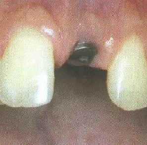 Implantat1.JPG (54804 Byte)