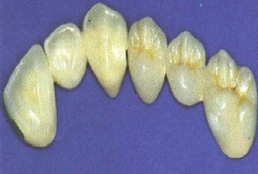 metallkeramik.JPG (119556 Byte)